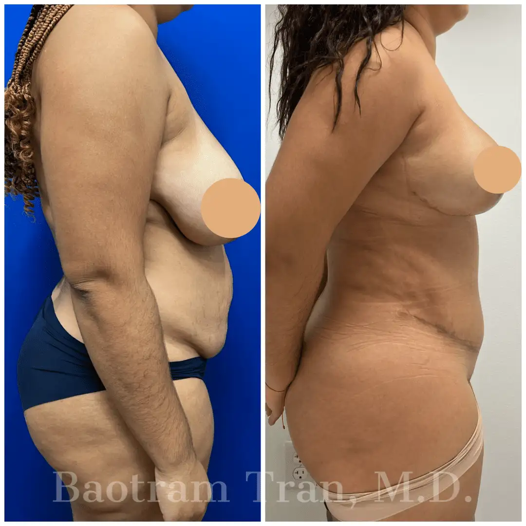 Before and After Image: Mommy Makeover - right-side