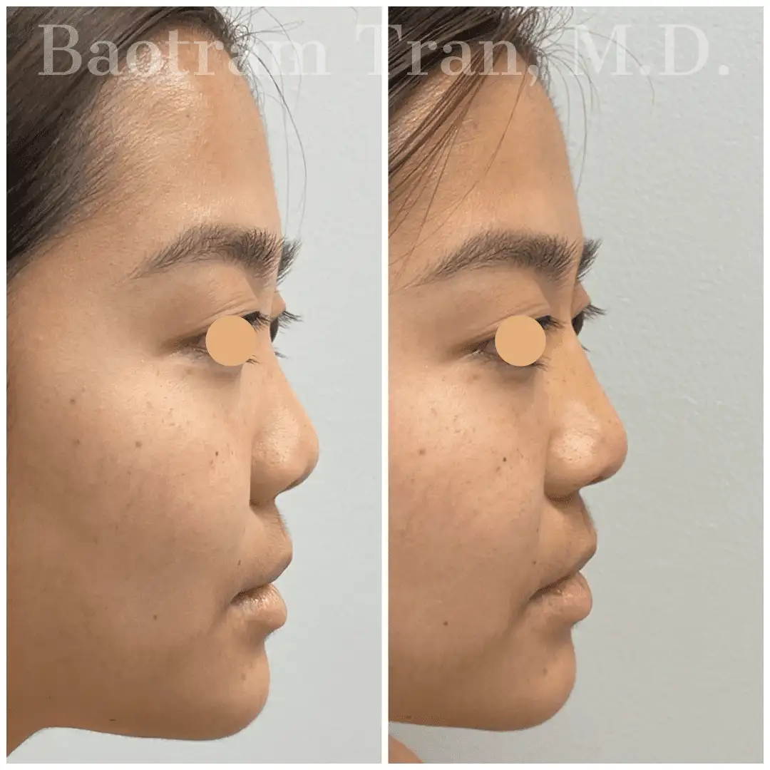 Before and After Image: Non-Surgical Procedure - right-side